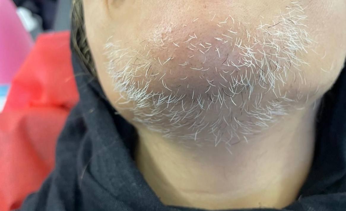 الکترولیز موهای سفید؛ تنها روش حذف دائمی موهای بدون رنگ